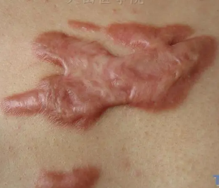 成纤维细胞与皮肤修复的关系