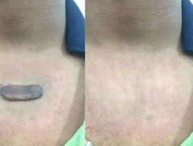 瘢痕疙瘩切除术后最佳剂量方案