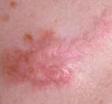 摆脱瘢痕疙瘩能做与不能做的事