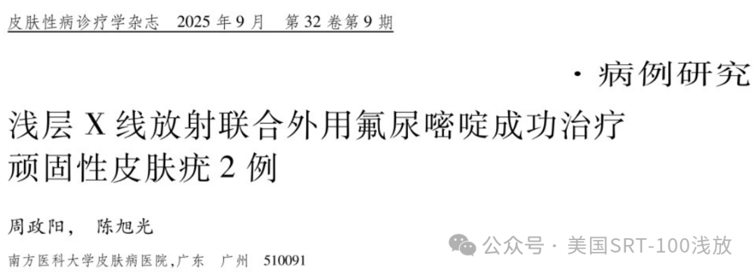 文献速递｜浅层Ｘ线放射联合外用氟尿嘧啶成功治疗顽固性皮肤疣